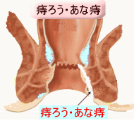痔ろう・あな痔