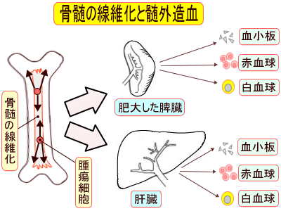 骨髄の線維化と髄外造血の説明図