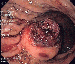 GIST：消化管間質腫瘍写真