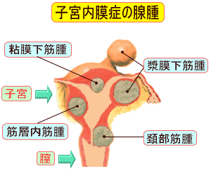 子宮内膜症の腺腫