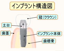 歯のインプラント説明図