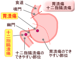 十二指腸潰瘍の図