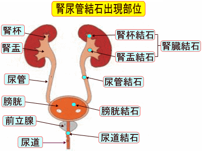 腎尿管結石