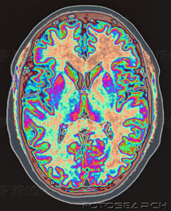 脳のMRI写真画像
