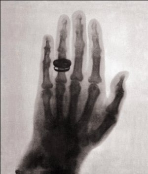 最初の人体X線写真